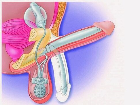 Ampliación de pene por prótesis de pene