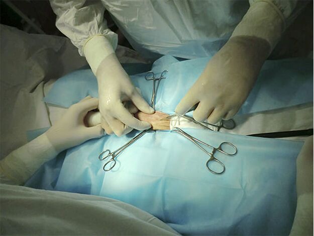 Cirugía de agrandamiento del pene